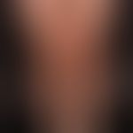 Hirsutismus. Ausgeprägtes, männliches Behaarungsmuster (Terminalhaare)&nbsp; bei einer ansonsten ...