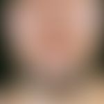 Hirsutismus. Ausgeprägtes, androgenabhängiges, männliches Behaarungsmuster (Terminalhaare) mit Be...