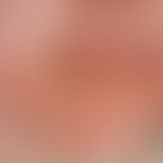 Herpes simplex labialis: super-infected herpes simplex labialis of the lower lip and the red of t...