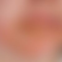 Herpes simplex labialis: super-infected herpes simplex labialis of the lower lip and the red of t...