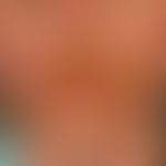 Herpes simplex disseminatus: extensive herpes simplex infection of the perioral region. massive b...