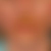 Herpes simplex disseminatus: ausgedehnte Herpes simplex Infektion der Perioralregion. Massive bak...