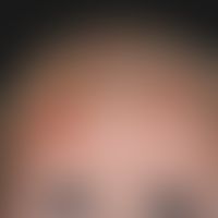 Impetigo contagiosa bei atotpischem Ekzem des Säuglings.

