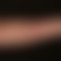 Dermatose, IgA-lineare. 29-Jährige Ptientin; seit mehreren&nbsp; Monaten rezidivierendes, vesikul...