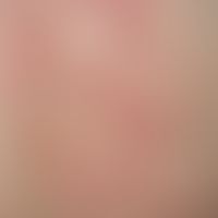 Dermatosis IgA-lineare: detailed picture with circulatory smaller and larger red blisters on urti...