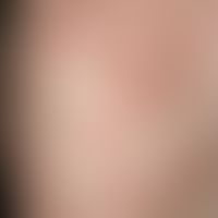 Dermatosis IgA-lineare: Circinarily arranged, smaller and larger, red blisters on a urticarial ba...