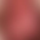 Dermatosis benign chronic bullous of childhood: bulging translucent blisters in a 2-year-old boy;...