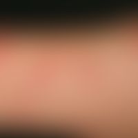 Insektenstiche (Übersicht): akut aufgetretene, disseminierte, juckende &nbsp;Bläschen und Pusteln...