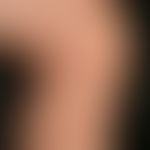 Insektenstiche (Übersicht): akut aufgetretene, disseminierte, juckende &nbsp;Bläschen und Pusteln...