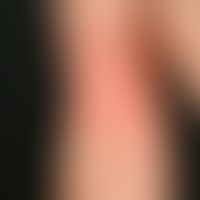 Insektenstiche (Übersicht): akute, diffuse, kollaterale Rötung und Schwellung nach Insektenstich.
