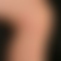 Culicosis bullosa: disseminerte blasige und pustulöse Insektenstichreaktionen, wenige Stunden nac...