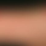 Mosquito bite: acutely occurring, disseminated, itchy papules, blisters and pustules with reddene...