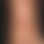 Mosquito bite: several days old, itchy bite reaction with central pustle formation (secondary pyo...
