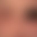 Lidschwellung: massive Anschwellung der Lider bei toxischer Reaktion auf ein Haarfärbemittel.
