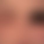 Lidschwellung: massive Anschwellung der Lider bei toxischer Reaktion auf ein Haarfärbemittel.
