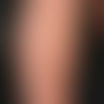 Blaschko-Linien: sog. ILVEN. Entzündliches lineares Hamartom der Haut das&nbsp;sich längs der Bla...