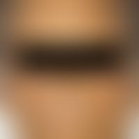 Ikterus bei Verschluss der Gallengänge.
