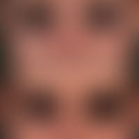 Rosacea papulopustulosa 2 years after "low dose - isotretinoin therapy".
