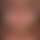 Rosacea papulopustulosa 2 Jahre low dose - Isotretinoin-Therapie.

