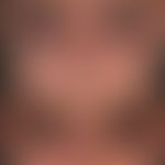 Rosacea papulopustulosa 2 years low dose - isotretinoin therapy.
