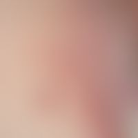Vulvovaginitis herpetica: Acute infection of the vulva and inguinal region at the first manifesta...