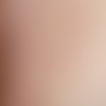 Vulvovaginitis herpetica: Acute infection of the vulva and inguinal region at first manifestation...