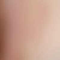 Vulvovaginitis herpetica: Acute infection of the vulva and inguinal region at first manifestation...