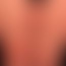 Pemphigoid nicht-bullöses: Prurigo-Form einer Pemphigoid-Erkrankung. Leitsympotm diese Krnakheits...