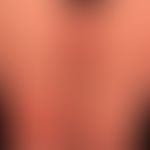 Pemphigoid nicht-bullöses: Prurigo-Form einer Pemphigoid-Erkrankung. Leitsympotm diese Krnakheits...