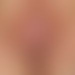 Kraurosis vulvae: Manifestation of a lichen sclerosu of the vulva (small and large labia, clitori...