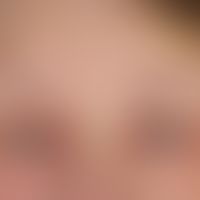 Ulerythema ophroygenes (hier atrophisches Endstadium): Kompletter Verlust der lateralen Augenbrau...