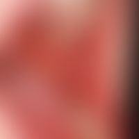 Peutz-Jeghers-Syndrom. Seit der frühesten Kindheit bestehende, schwarzbraune, spritzerartige brau...