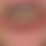 Peutz-Jeghers syndrome: (familial) lentiginosis of the red of the lips, lip and oral mucosa known...