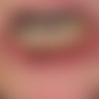 Peutz-Jeghers-Syndrom: seit frühester Kindheit bekannte&nbsp;(familiäre) Lentiginose von Lippenro...