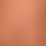 Larva migrans: after a tropical beach holiday several weeks ago, at times clearly itchy, still in...
