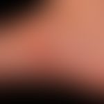 Larva migrans. linear plaque, subepidermally situated, tortuous, constantly itching gait on the r...