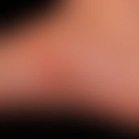Larva migrans. linear plaque, subepidermally situated, tortuous, constantly itching gait on the r...