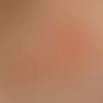 Larva migrans: Gait in reflected light microscopy
