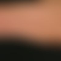 Leser-Trélat-Syndrom: seit&nbsp;2 Jahren plötzlich aufgetretene, flächig verruköse&nbsp; Hautbesc...