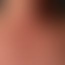 Reader-Trélat-Syndrome: since 2 years suddenly appeared, flatly verrucous skin condition with mul...