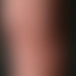 Keratoses seborrhoeic: multiple skin-colored flat wart-like papules and plaques. occasional itchi...