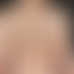 keratosis seborrhoeic: multiple flat wart-like skin growths that have persisted for years. arrows...