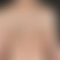 keratosis seborrhoeic: multiple flat wart-like skin growths that have persisted for years. arrows...