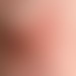 Lichen simplex chronicus:&nbsp;chronische Plaque aus randlich disseminierten, festen, roten Papel...