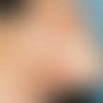 Leishmaniosis recidivans: kutane Leishmaniose mit 2 utnerschiedlich großen, schmerzlosen, bräunli...