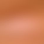 Lipoatrophie, lokalisierte nach Glukokortikosteroid-Injektionen. Eingesunkenes Areal mit weißlich...