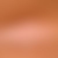 Lipoatrophie, lokalisierte nach Glukokortikosteroid-Injektionen. Eingesunkenes Areal mit weißlich...