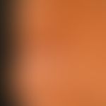 Lipoatrophie, lokalisierte nach Glukokortikosteroid-Injektionen. Eingesunkenes Areal mit weißlich...