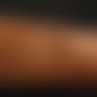 Lipoatrophie, lokalisierte nach mehrfachen Glukokortikosteroid-Injektionen wegen Bursitis. Mit Pf...