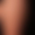 Lipoatrophia semicircularis: seit einem halben Jahr bestehende, vollkommen symptomlose, streifige...